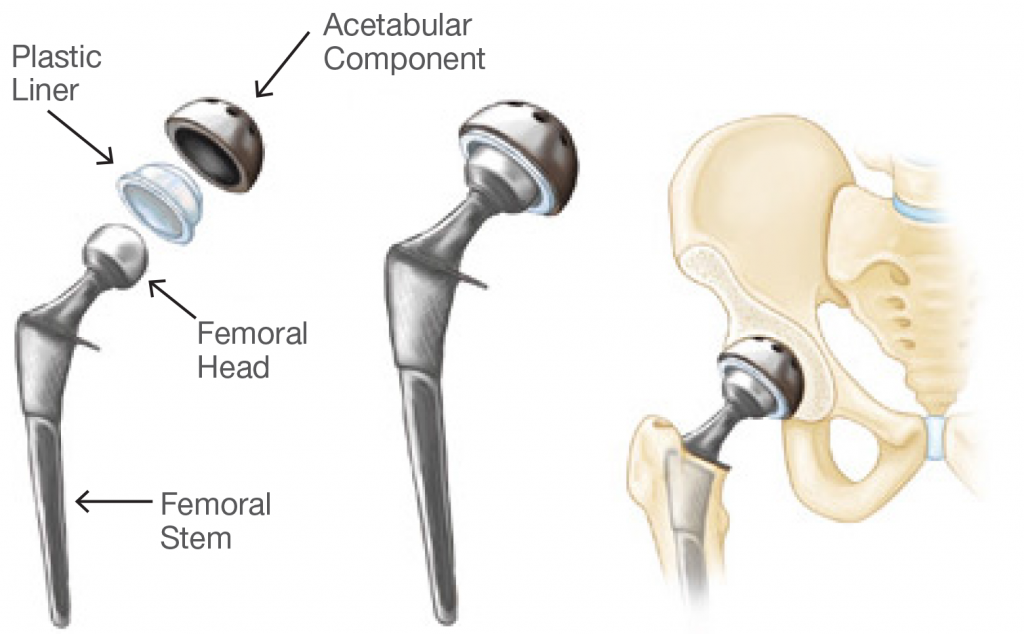 Total Hip Replacement Orthodoctor Waverley Orthopaedic Clinic
